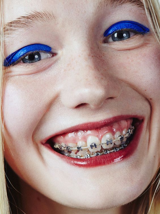 a close up of a young girl with braces on her teeth