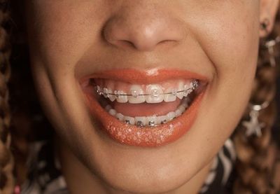 a close up of a woman with braces on her teeth