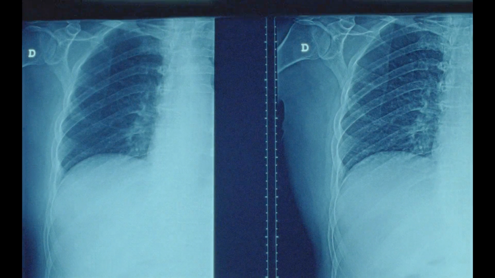 a radiograph of a person's arm and arm bones