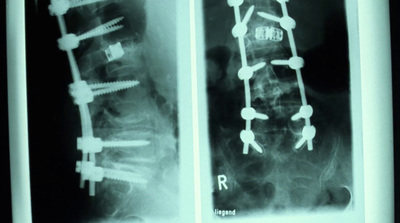 a x - ray of a man's chest and chest